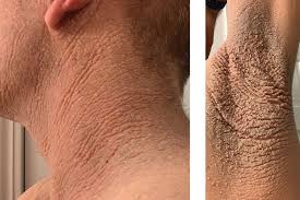 Image result for Diffuse Hyperpigmentation