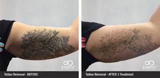 Picoway is an excellent laser that we use in our nyc practice for tattoo removal. Tattoo Removal Okc 10 Off In January 1 Rated Clinic In Oklahoma Longevity