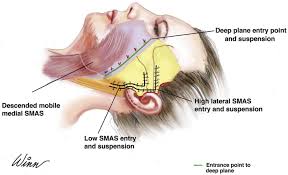 Extended Deep Plane Facelift Clinics In Plastic Surgery