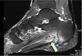 The purpose of this study was to investigate the relationship of muscle mri findings and gait all dm1 patients presenting with foot drop showed high intensity signals in the tibialis anterior muscles on. Joaznoticias