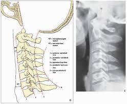 Lower 1/2 of l4 or the l4/l5 ivd space. Spine Radiology Key