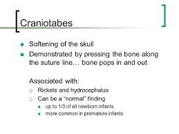 Image result for Craniotabes