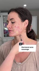 Envie Concealer: Perfect Spot Concealer to Cover Acne Marks