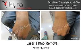 Removery is here to guide you through your tattoo removal journey. Before After Laser Tattoo Removal Cosmetic Surgery In Ludhiana Plastic Surgery In Punjab Laser And Cosmetic Surgeon In Ludhiana Punjab India
