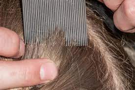 On blonde hair, they can look like very small black sesame seeds. What Do Lice Look Like 20 Close Up Pictures Of Lice Pest Strategies