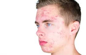 Akne Naturlich Behandeln Tipps Und Hausmittel Phytodoc