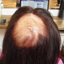 A hair salon is a place where one goes to get their hair done so that it can look beautiful and attractive. Trichotillomania And Hair Pulling Lucinda Ellery Inc Us La And Nyc