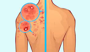 spora basladiktan sonra olusan sivilceler nasil gecer bodyforumtr blog