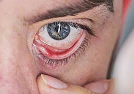 Zuerst spannt das augenlid nur etwas, dann drückt und schmerzt es, eine rote knötchen am augenlid. Lidrandentzundung Blepharitis Tears Again