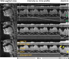 The popular mp3 codec is an example of a lossy encoding technique. A Multispeaker Dataset Of Raw And Reconstructed Speech Production Real Time Mri Video And 3d Volumetric Images Scientific Data