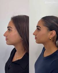 To discuss personalised services, volume loss, wrinkles, disproportionate  facial features or skin concerns with a health professional, kindly  schedule a comprehensive consultation through the link provided in my bio.  During this consultation,