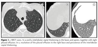 These cells malfunction and, over time, die. Scielo Brasil Transplante Hepatico Em Paciente Portadora De Doenca De Niemann Pick Com Envolvimento Pulmonar Transplante Hepatico Em Paciente Portadora De Doenca De Niemann Pick Com Envolvimento Pulmonar
