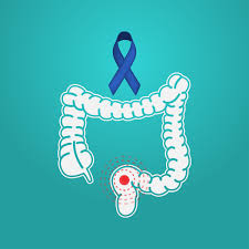 The graft is used to reconnect the remaining esophagus and stomach. Colon Cancer Screening Guideline Age Lowered Cohen Medical Associates
