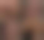 Image result for Pyoderma Gangrenosum