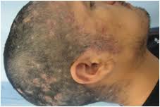 Sore throat, hair loss, vision changes and extreme fatigue can also occur. Https Www Longdom Org Open Access Simultaneous Primary And Secondary Syphilis Associated With Syphilitic Alopecia And Folliculitis In An Hiv Positive Patient 2167 0951 1000108 Pdf