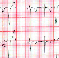 Image result for Epsilon Wave