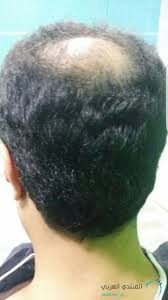 تجربتي زراعة الشعر في تركيا مع مركز رويال هير المنتدى العربي لزراعة الشعر وعلاج الصلع