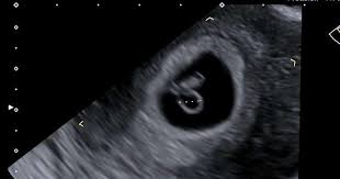 What to expect at your 7 weeks pregnancy ultrasound. 7 Week Baby Ultrasound Scan International Ultrasound Services