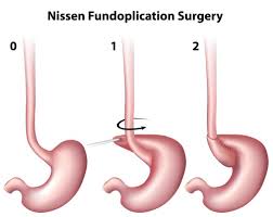 Hiatal Hernia Do I Need Mine Fixed