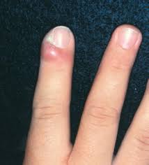 Image result for paronychium