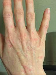 Life With Chronic Urticaria The Dad Network Urticaria Chronic Hives Skin Disorders And Diseases