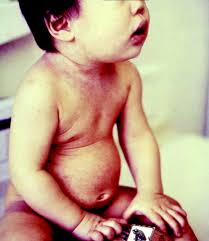 Babies normally exhibit a patchy skin because of their immature circulatory system. 8 Management Of Allergy Rashes And Itching Emergency Medicine Journal