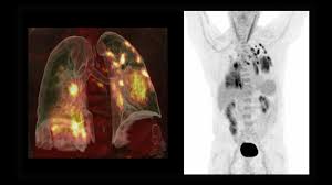 Image result for Incidental Imaging Finding