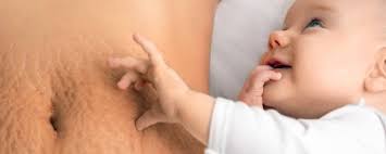 8 Cara Alami & Medis Menghilangkan Stretch Mark!