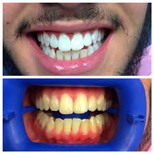 Brush your teeth before you apply your whitening strips. Teeth Whitening Irving Tx Irving Family Dental