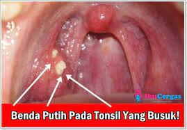 Bila aimi demam, mesti kena tonsil. Derita Sakit Bengkak Tonsil Dan Ubat Sakit Tonsil Semulajadi