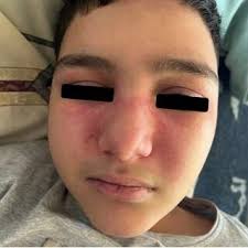 PDF) FROM DERMATOMYOSITIS SINE DERMATITIS TO A COMPLETE FORM OF JUVENILE  DERMATOMYOSITIS: AN INTRIGUING CASE REPORT!