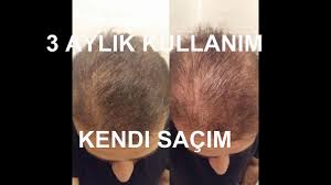 Sac Cikaran Binox Kullananlar Yorumlari Ve Oncesi Sonrasi Resimleri Binox Igneli Tarak Serum Sampuan Youtube