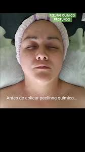 Peeling Quimico Cochabamba