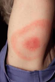 Lyme Disease Infectious Diseases Msd Manual Professional Edition