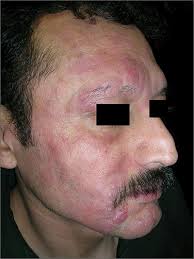 Many women experience this postpartum as well as during menopause. Rash With Hair Loss Mdedge Family Medicine