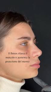 Botox per la proiezione del mento. #botox #botoxmento #mento #botulin  #medicinaestetica #medicinaesteticamilano #napoli #skincare #pelle  #saraizzoreal #si #tiktok #ringiovanimentoviso