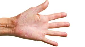 Honey or lemon can be added to the water for the best benefits. Cracks Fissures Eczema And Your Hands Dermatology Skin Health