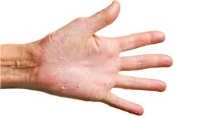 Honey or lemon can be added to the water for the best benefits. Cracks Fissures Eczema And Your Hands Dermatology Skin Health