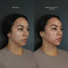 🖤 Full Face Contouring 🖤 To achieve a more lifted and sculpted look, I  used filler to contour the jawline, chin, and cheeks in this lovely  patient. The results are transformative, yet