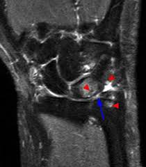 Steven Lee, Md | Ulnar Impaction Syndrome Orthopedic Hand Doctor| Nyc
