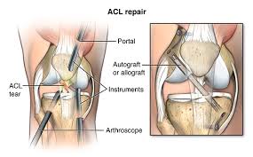 Get your query answered 24*7 only on | practo consult. Knee Ligament Repair Johns Hopkins Medicine