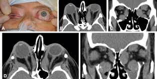 Orbital Inflammation An Overview Sciencedirect Topics