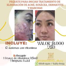 ✨Tu piel merece lo mejor y en Centro de Belleza D'Lucy lo sabemos✨ ✨Por eso  en esta semana tenemos promociones imperdibles para iniciar tu tratamiento  de acné, rosácea, dermatitis y manchas✨ Es