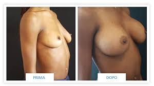 Prima e dopo chirurgia protesi 320 cc anatomiche Mastoplastica additiva