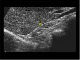 Wk 3 Adrenal Glands Abdomen And Retroperitoneum 1 10 Adrenal Glands Case 1 10 1 Normal Adrenals Ultrasound Cases Adrenal Glands Adrenals Abdomen
