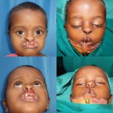 ANNUAL REPORT 2021 Hyderabad Cleft Society