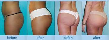 We did not find results for: Brazilian Butt Lift Miami Buttocks Augmentation Miami