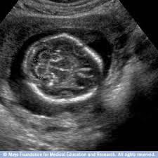 صور مراحل نمو الجنين بالموجات فوق الصوتية ويب طب