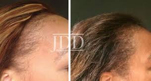 Complete hair regrowth achieved with topical vitamin d. A Closer Look At A Multi Targeted Approach To Hair Loss In African American Women Next Steps In Dermatology