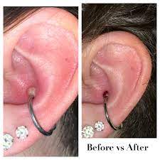 I Got My Conch Piercing Around Thanksgiving And It Just Flared Up Really Bad Recently It Got A Very Large Pus Filled Bump And When I Accidentally Hit It And It Popped